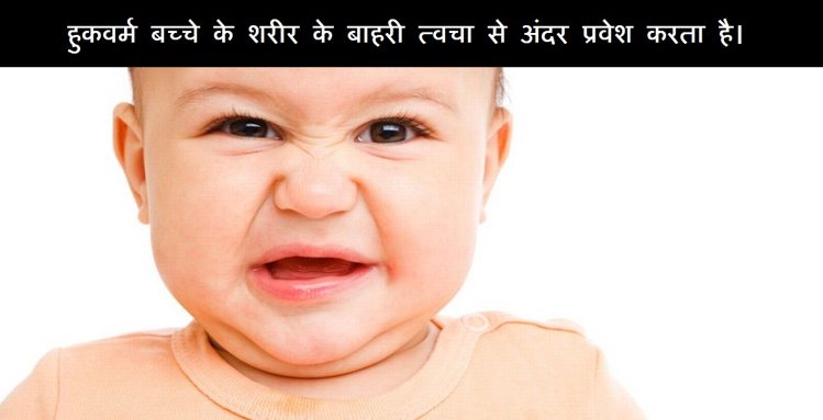 symptom of intestine worm in children
